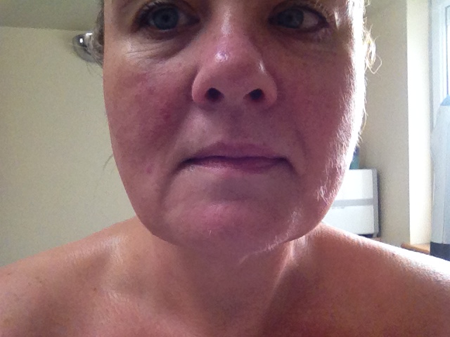 VIORA mid-treatment2